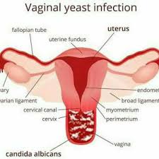 fungal infections
