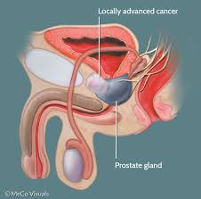 prostate
